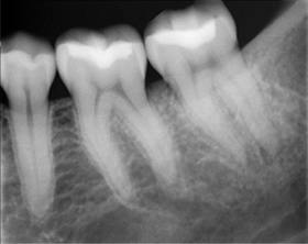 XDR Endo Original