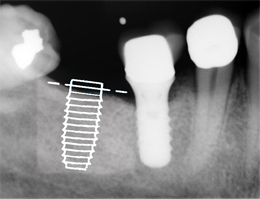 XDR Implant Overlay