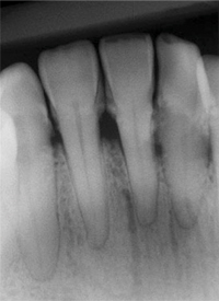 XDR Perio Original